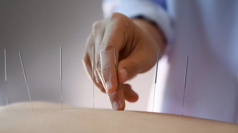 Acupuncture in Mt Pleasant